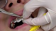 How do I Know When my Braces are Ready to be Removed?