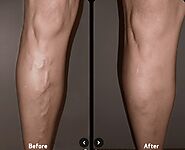 BEFORE AND AFTER VEIN TREATMENT IMAGE