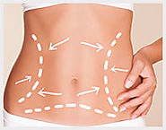 Tighten Your Belly Skin with Tummy Tuck or Abdominoplasty