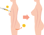 Effectiveness of Body Fat Transfer Procedure