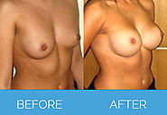 All You Need to Know about Breast Enlargement Surgery | Nu Cosmetic Clinic