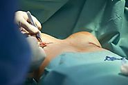 What Does Breast Enlargement Surgery Involve?