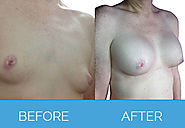 Breast Augmentation After Effects - UK London Liverpool Manchester