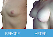 Get more Details about Breast Enlargement