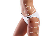 Get Rid of Stretch Marks or Cellulite with Carboxytherapy - Non-Surgical Skin Treatment