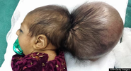 Recém-nascido com uma cabeça extra passa por operação no Afeganistão | Ciência Online - Saúde, Tecnologia, Ciência