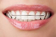 The Top 10 Differences between Dental Braces and Retainers