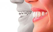 10 Differences between Dental Braces and Dental Implants | Vita Care