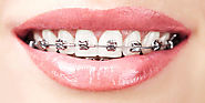 Website at https://www.vitadentalhouston.com/blog/braces-vs-dentures/
