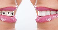 Braces Vs Invisalign- Best Option for Overbite Treatment | Vita Dentist