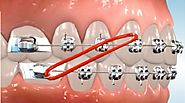 What are the elastics and Where to put It? | Braces orthodontics