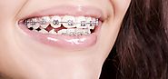 Why you Require to Visit your Orthodontist during Braces Treatment? Reason