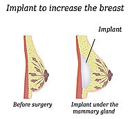 Know more about Breast Implant Replacement