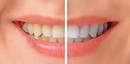 Health and Tooth Whitening - News Las Vegas