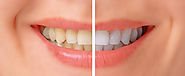Top 5 Home Teeth Whitening Methods - Health E Happy