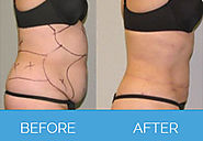 Want to Go for Liposuction? 5 Important Things You Need to Know about it