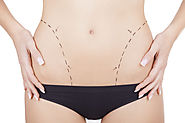 Should You Go for Liposuction after Pregnancy?
