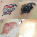 Unwanted tattoos can be removed by cream injected into skin - without pain or scarring