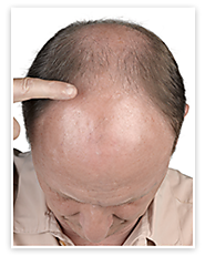 How can You Recover from Hair Loss Problems?