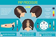 Is PRP Therapy an Effective Treatment for Pattern Baldness?