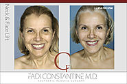 Facelift - Constantine Plastic Surgery