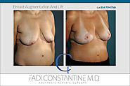 BREAST LIFT - COnstantine Plastic Surgery