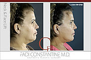 NECKLIFT - Constantine Plastic Surgery