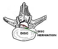 Herniated Discs Causes, Complication, Treatment And Prevention