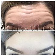 Protect & Nourish Skin Using Anti Wrinkle Injections