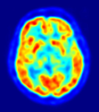 PET Scans Could Aid Huntingtons Disease Research