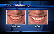 Sarasota Tooth Whitening Specialists | Sarasota Smile Design