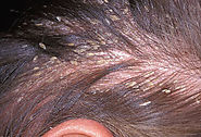 Hair Transplant is Permanent Solution for Hair Fall-Udaipurhairtransplant