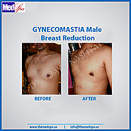 Gynecomastia Treatment in Delhi – Know more about its Symptoms