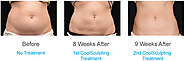 Coolsculpting for belly fat