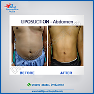 Best Liposuction in Delhi, India - Find Cosmetic Surgeon