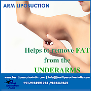 Arm liposuction surgery – benefits!