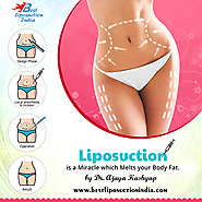 Vaser Liposuction