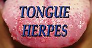 Herpes On Tongue: Causes, Symptoms And Guaranteed Natural Treatment