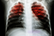 TUBERCULOSIS IS IN THE AIR