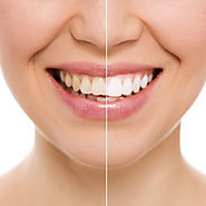 Teeth Whitening in New Friends Colony - Friends Dental Studio
