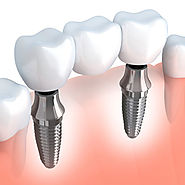 Dental Implants in South Delhi - Friends Dental Studio