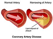 Coronary Angioplasty: A Life Saving Procedure