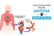 What Causes Heart Failure – Angina Or Heart Attack?