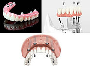 Flexible dentures Sydney - Denture Care Clinic
