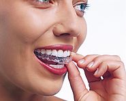 Clear aligners can be removed