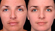 Meladerm For Hyperpigmentation before and after