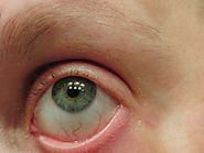 Signs and symptoms of surfer’s eye
