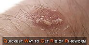 Top 10 Quickest Way to Get Rid of Ringworm | How to Cure Ringworm Fast