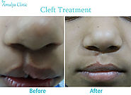 looking for Cleft Lip treatment and Palate treatment in New Delhi, Cleft Lip Doctor: Amulya Clinic
