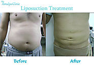 Looking for Liposuction and Cosmetic surgeon in Delhi NCR : Amulya Clinic